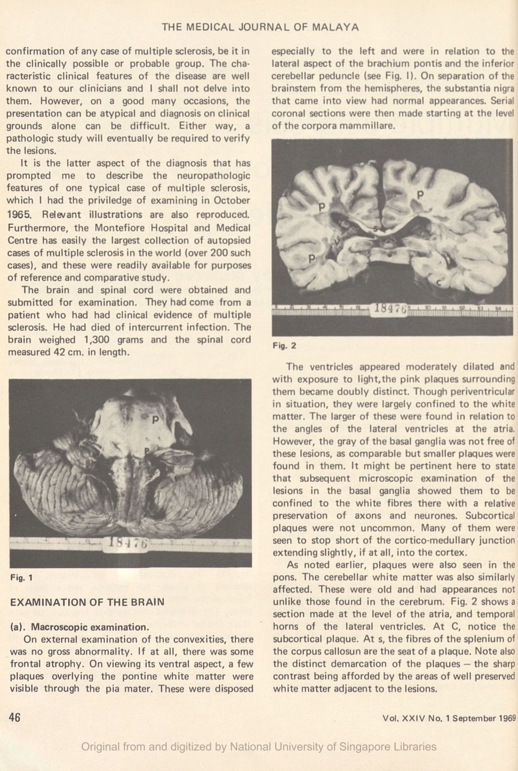 Miniature of Multiple sclerosis - the neuropathology of a case with a plea