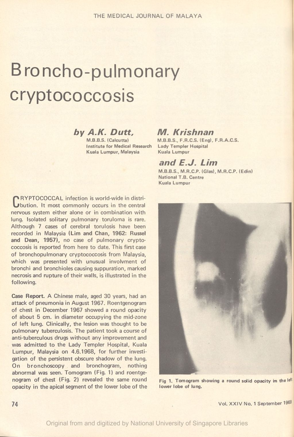 Miniature of Broncho pulmonary cryptococcosis